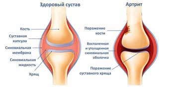 Лечение артрита суставов